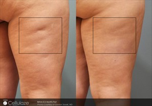 cellulaze_sasaki0202_6monthsposttx