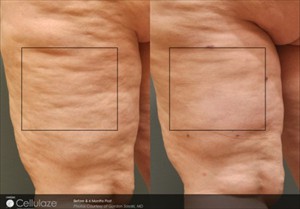cellulaze_sasaki0207_6monthsposttx