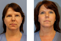 Before and After Photos