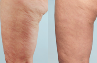 Banish Cellulite